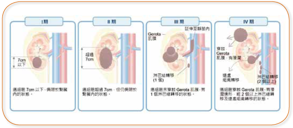 転移性腎細胞癌の治療